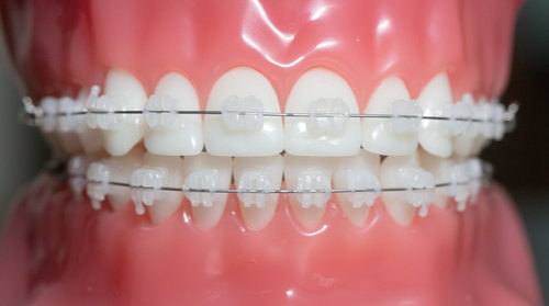 Orthodontic Treatment
