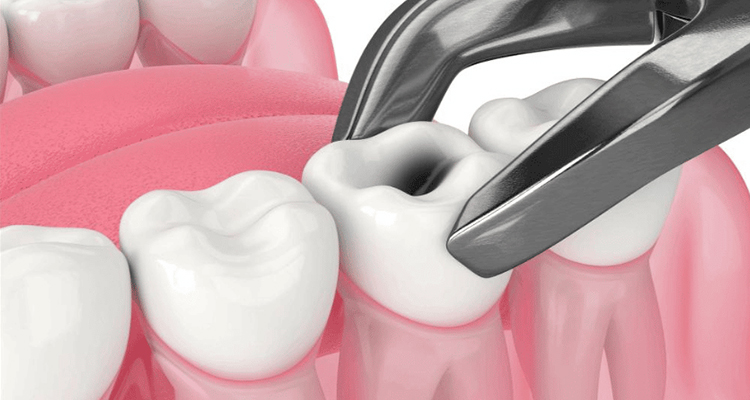 Painless Tooth Extraction