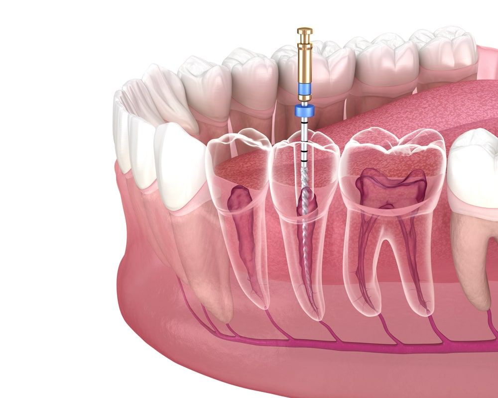 Root Canal Retreatment